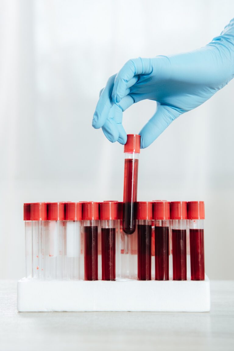 Blood Tests Near Me: Blood Test at Home | Your Convenient Path to Accurate and Reliable Results Blood Tests Near Me Blood Test at Home Your Convenient Path to Accurate and Reliable Results