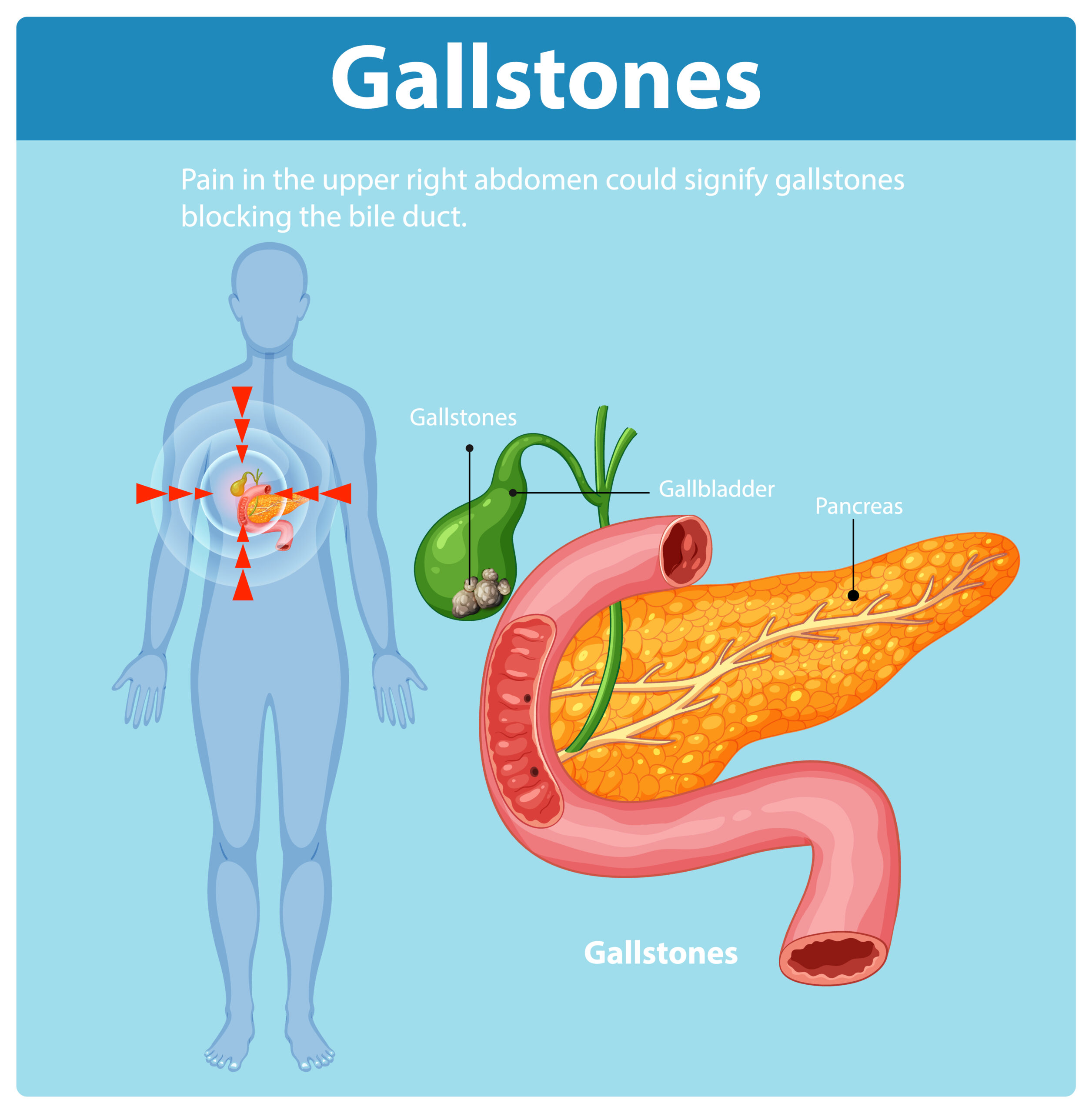 Gallbladder Stone Symptoms Causes And Treatment Gallstones Gallbladder Stone Symptoms Causes And Treatment Gallstones